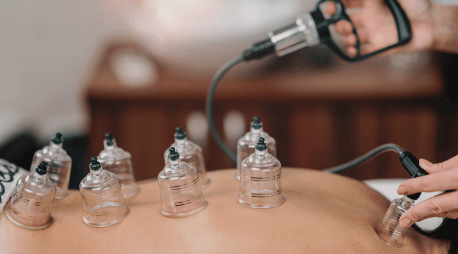 Patient receiving cupping therapy as part of chiropractic treatment in Milwaukie
